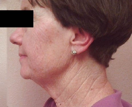 noninvasive