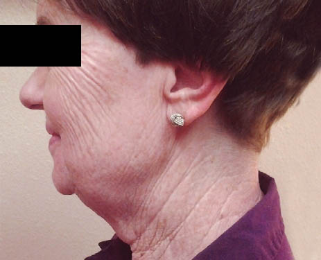 noninvasive2-before